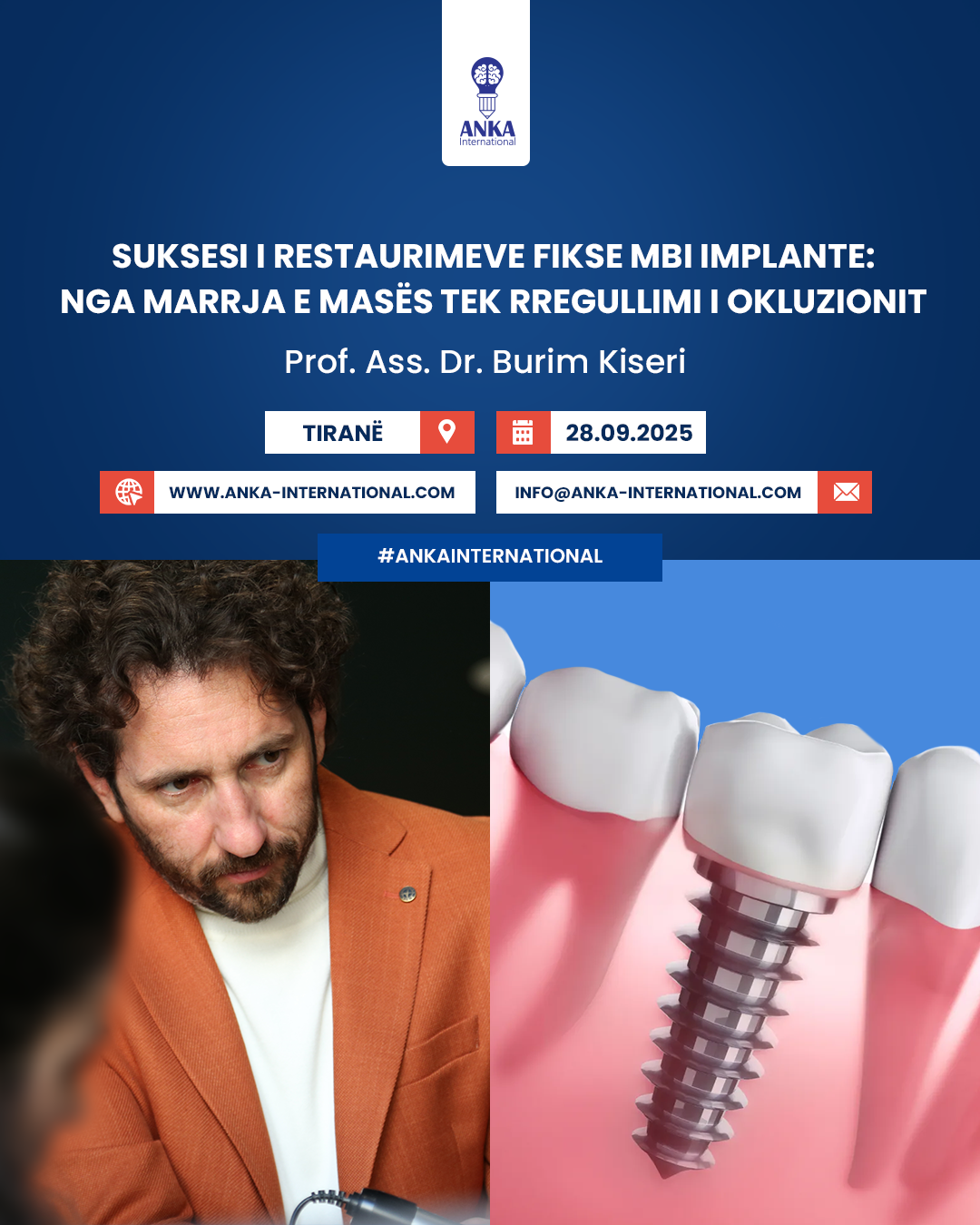 Suksesi i restaurimeve fikse mbi implante: Nga marrja e masës tek rregullimi i okluzionit