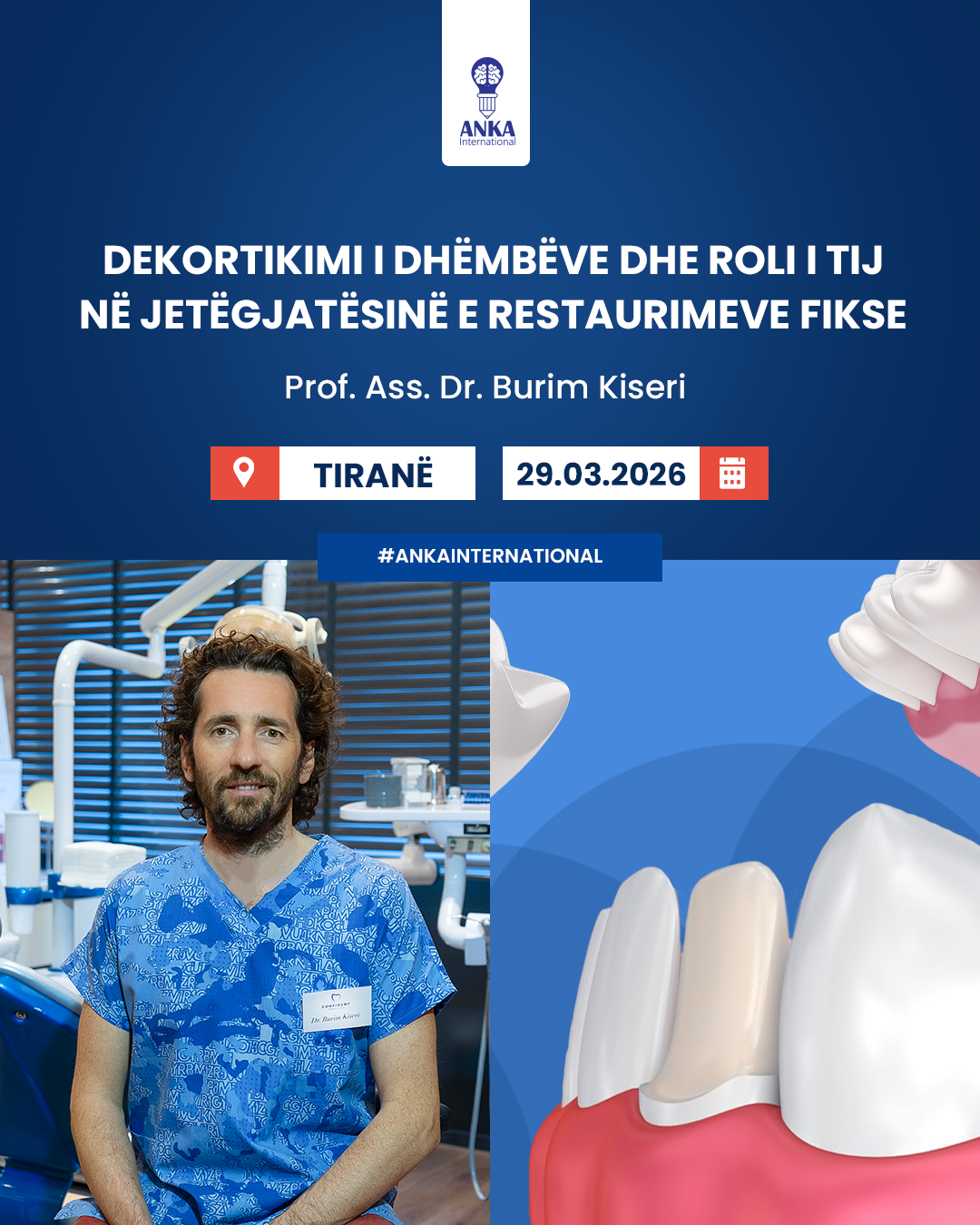 Dekortikimi i dhëmbëve dhe roli i tij në jetëgjatësinë e restaurimeve fikse